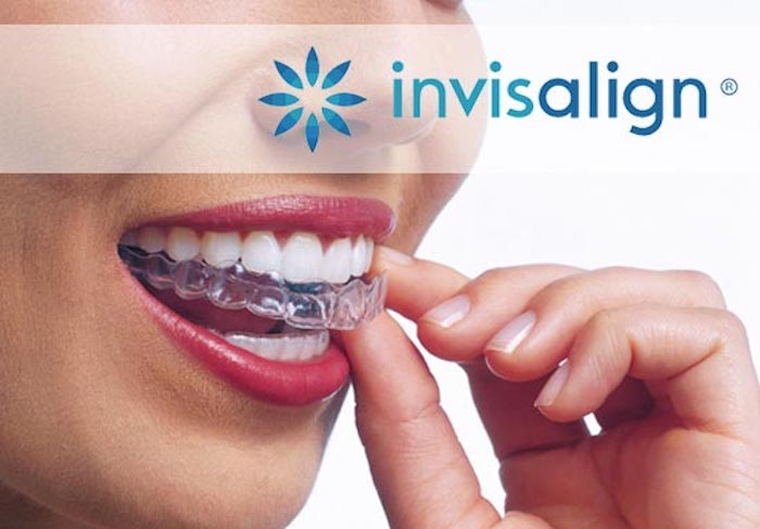 Bello Dente Odontologia  Aparelho invisível Invisalign® - Vale a pena o  investimento?